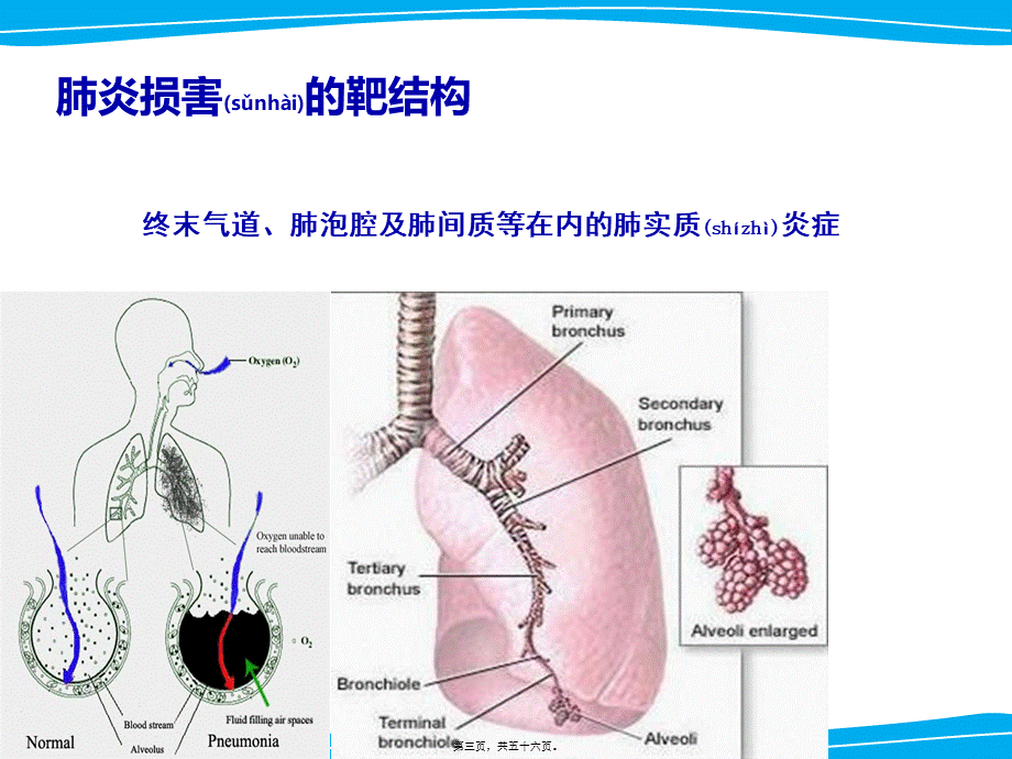 2022年医学专题—严重肺部感染诊治策略.ppt_第3页