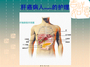 2022年医学专题—肝癌ppt-原发性肝癌(1).ppt