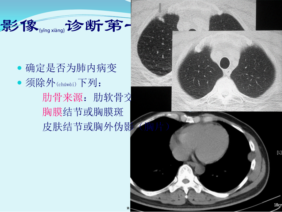 2022年医学专题—胸部CT肺内孤立性结节.ppt_第3页