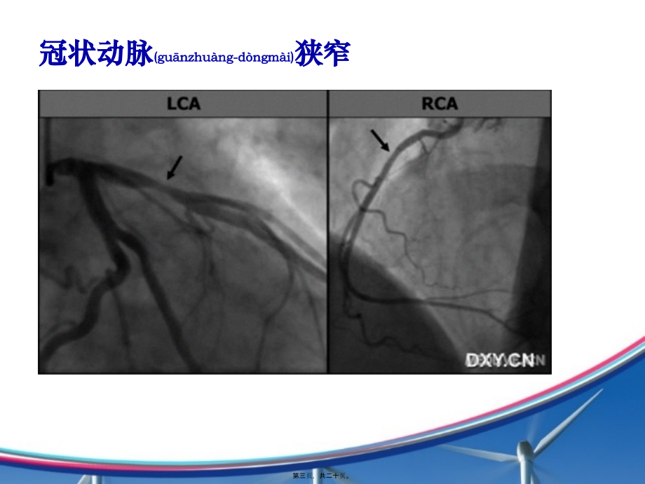 2022年医学专题—冠状动脉病变类型.ppt_第3页