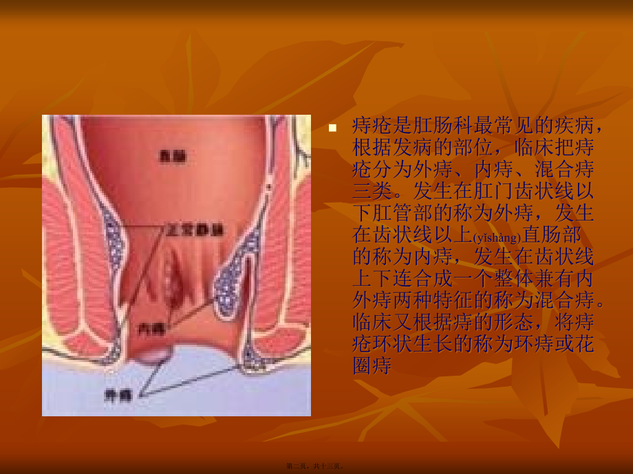 2022年医学专题—痔疮.ppt_第2页