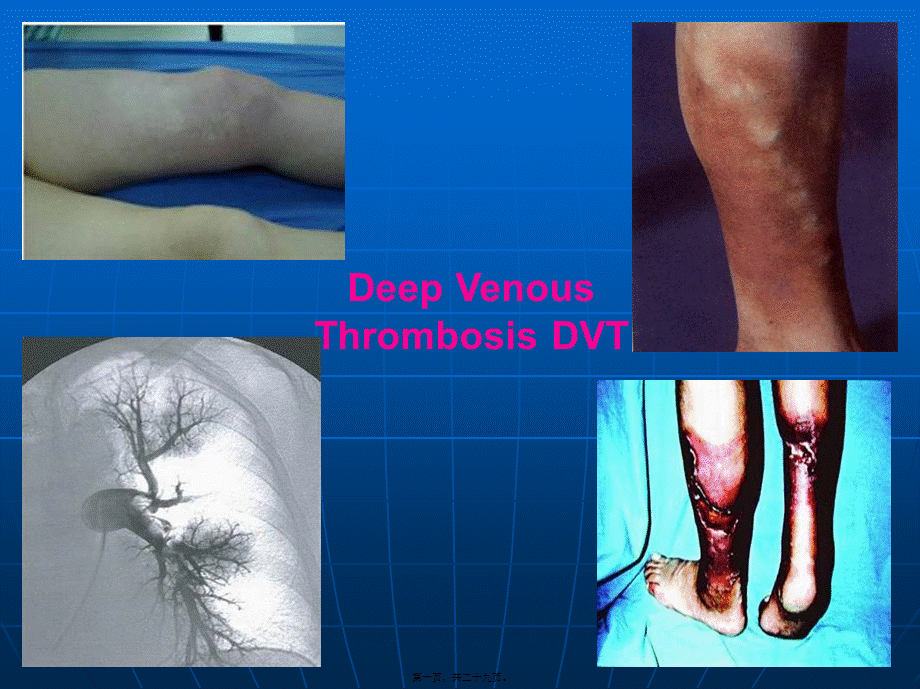 2022年医学专题—深静脉血栓诊治(1).ppt_第1页