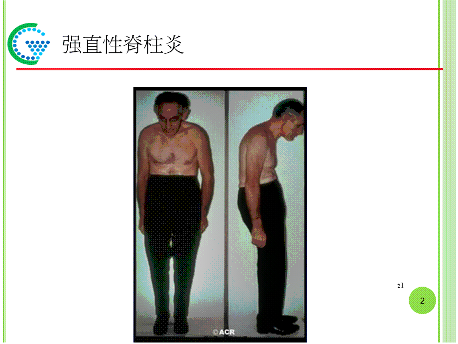 2022年医学专题—强克与强直性脊柱炎(1).ppt_第2页