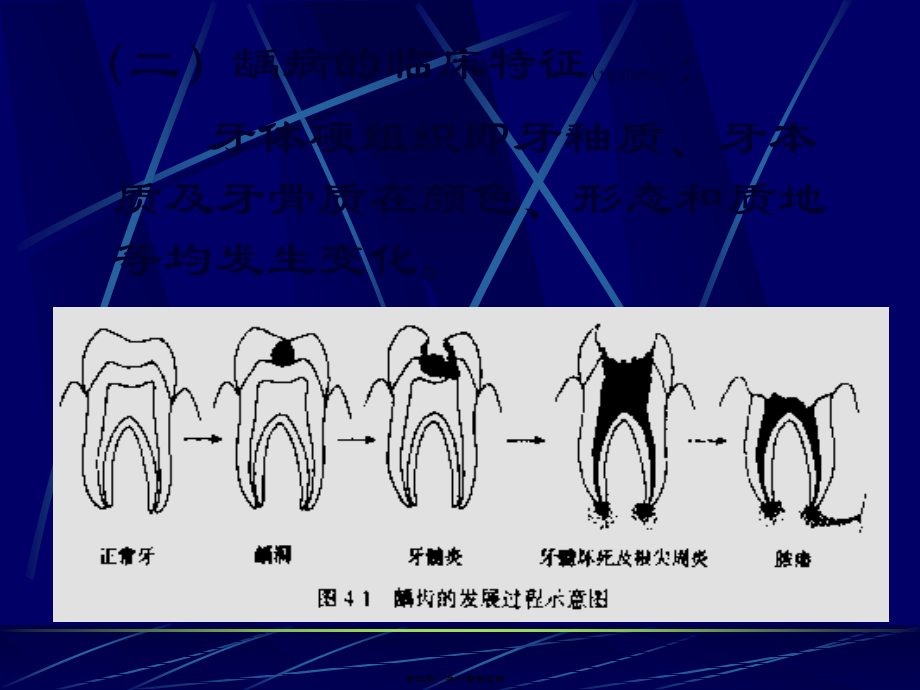 2022年医学专题—牙体牙髓常见病龋病.ppt_第3页