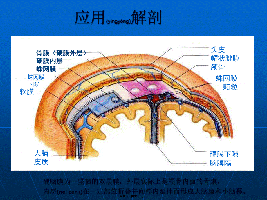 2022年医学专题—小脑幕硬膜下血肿.ppt_第3页