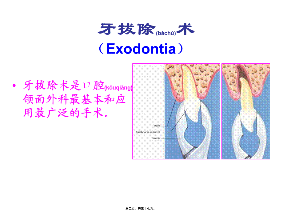 2022年医学专题—拔牙术2014.9.17(1).ppt_第2页