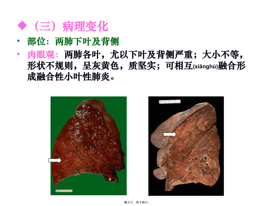 2022年医学专题—大叶性肺炎、小叶性肺炎、间质性肺炎(下部分)(1).ppt_第3页