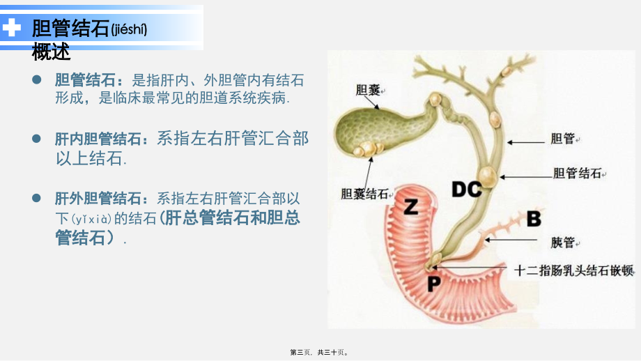 2022年医学专题—胆管结石(1).ppt_第3页