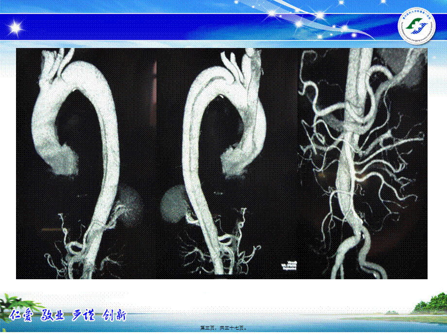 2022年医学专题—主动脉夹层的诊疗及处理策略(1).pptx_第3页