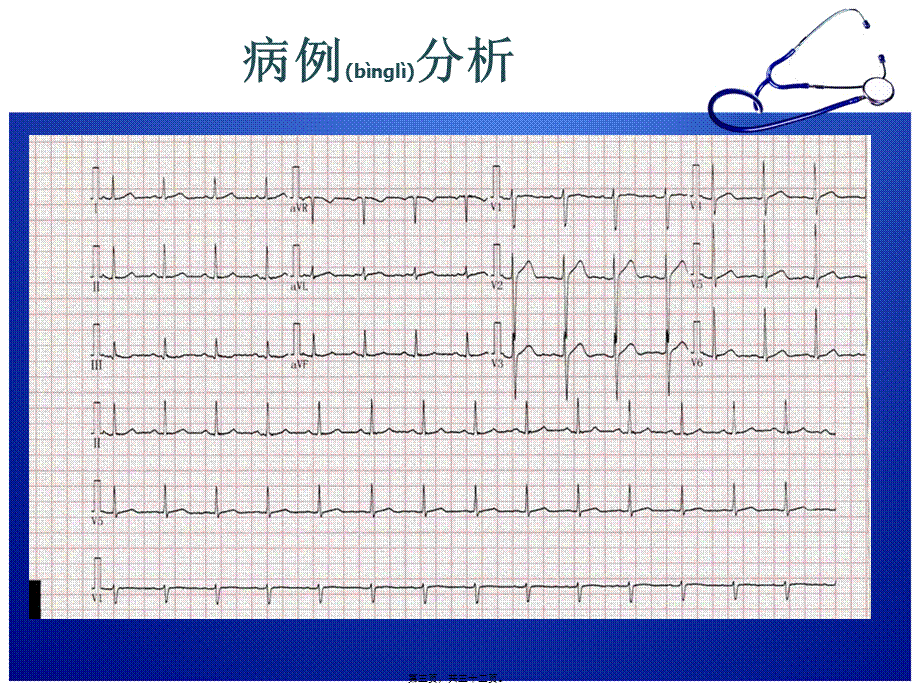 2022年医学专题—急性胸痛诊治流程(1).ppt_第3页