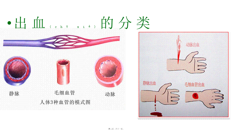 2022年医学专题—外伤出血的处理(1)(1).pptx_第2页