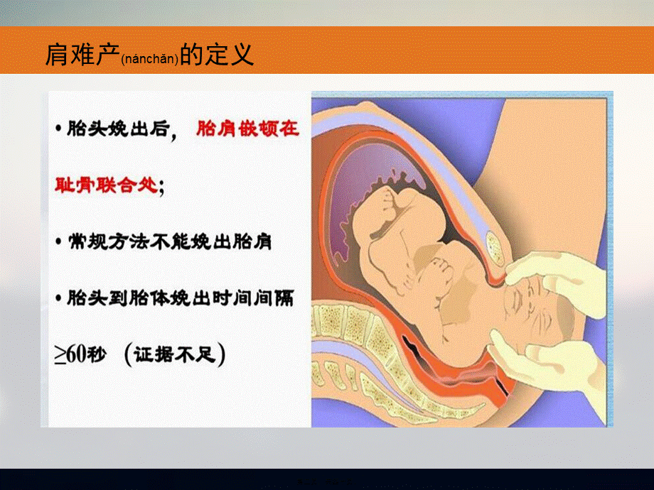 2022年医学专题—肩难产的紧急处理-张孝平(1).ppt_第2页