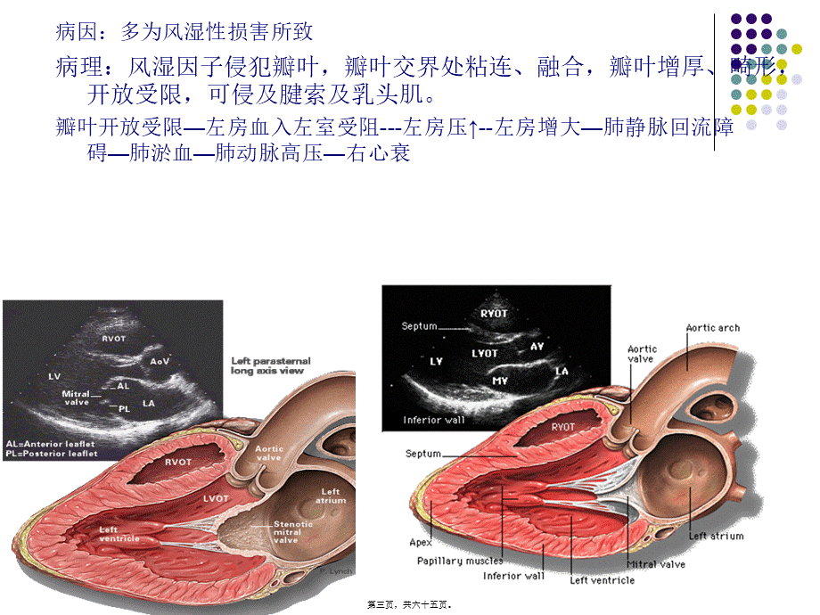 后天获得性心脏病瓣膜病.pptx_第3页