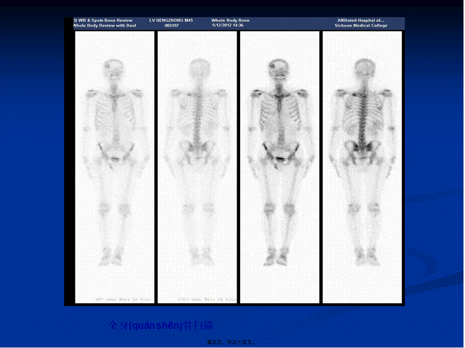 2022年医学专题—mTc-MDP骨显像骨外异常显影(1).ppt_第3页