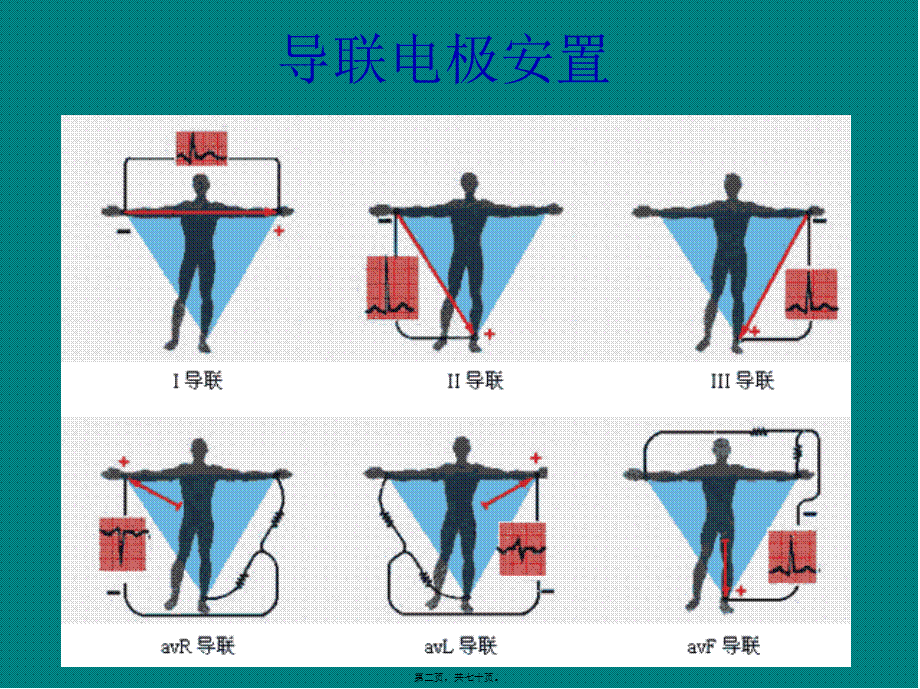 冠心病的心电图表现.pptx_第2页