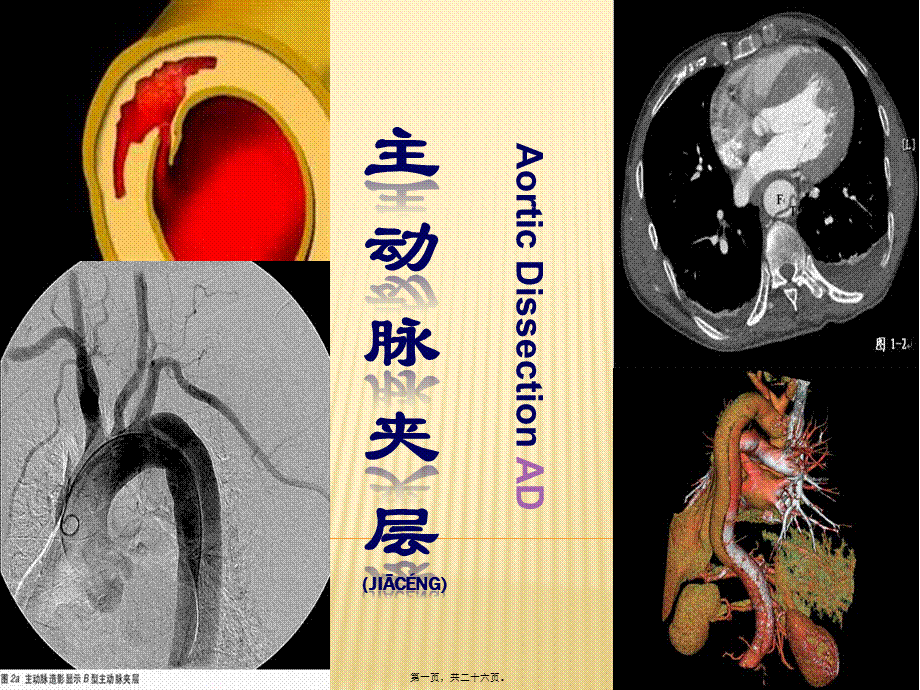 2022年医学专题—主动脉夹层-ppt.pptx_第1页