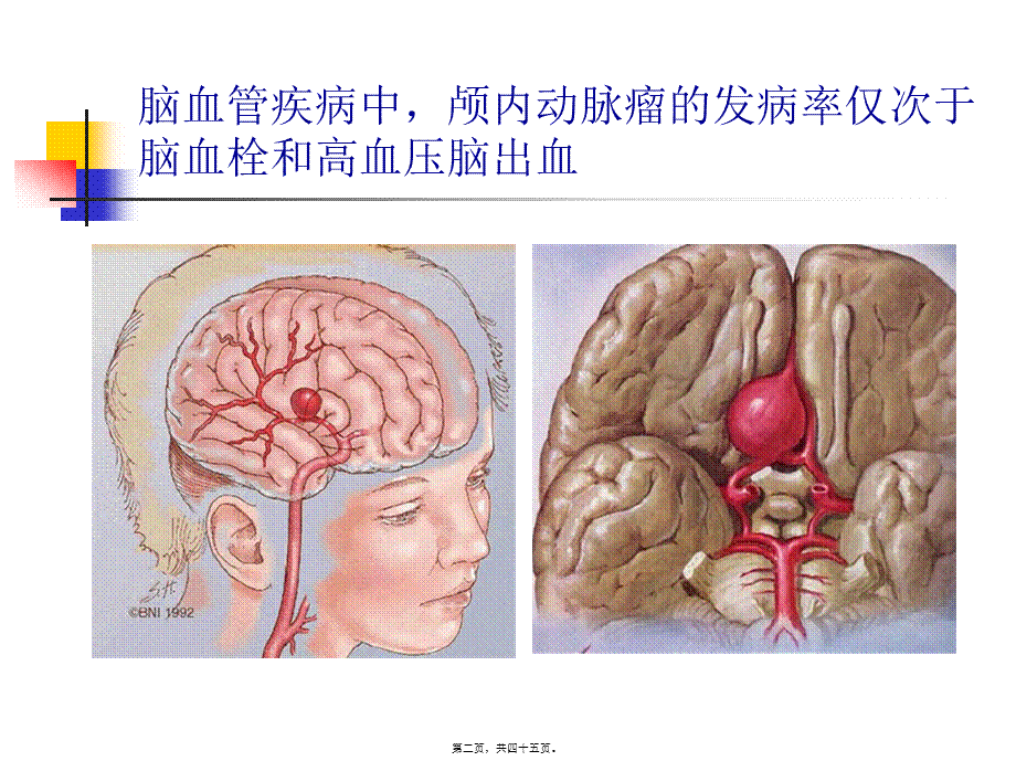 动脉瘤手术配合.ppt_第2页