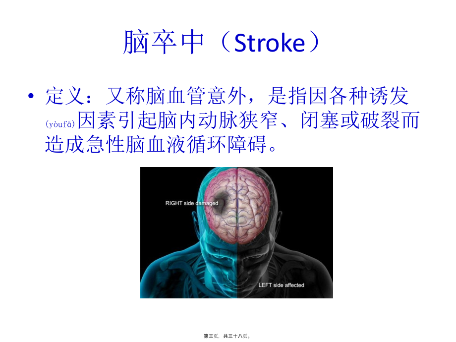 2022年医学专题—脑卒中的症状和定位[1].pptx_第3页