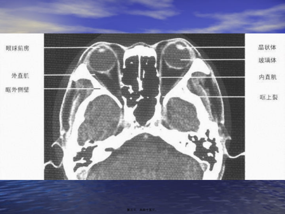 2022年医学专题—头颈部CT.ppt_第3页