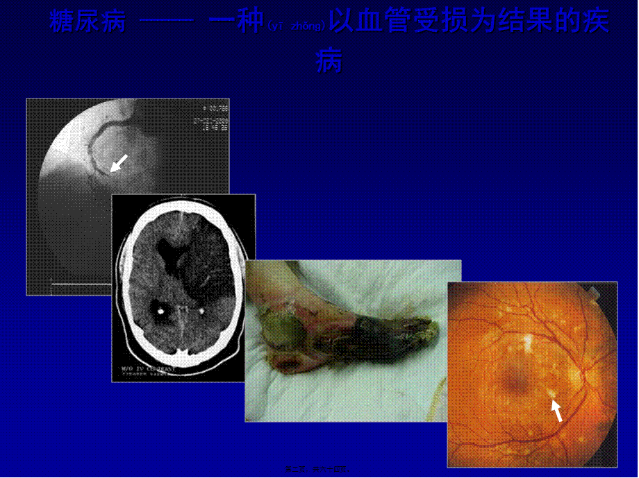 2022年医学专题—糖尿病大血管并发症.ppt_第2页