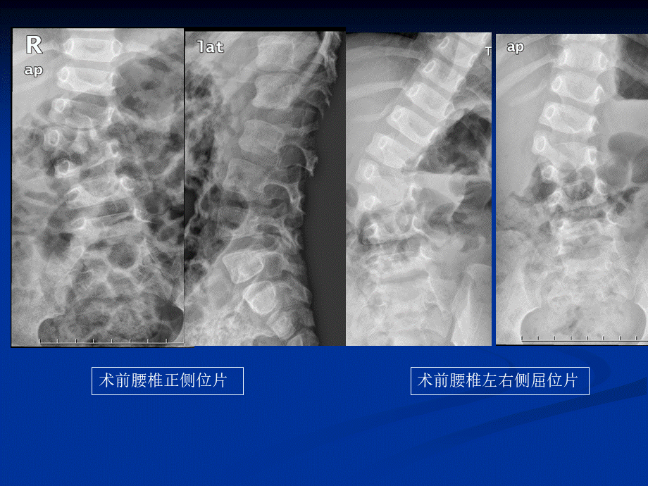 pso截骨(1).ppt_第2页