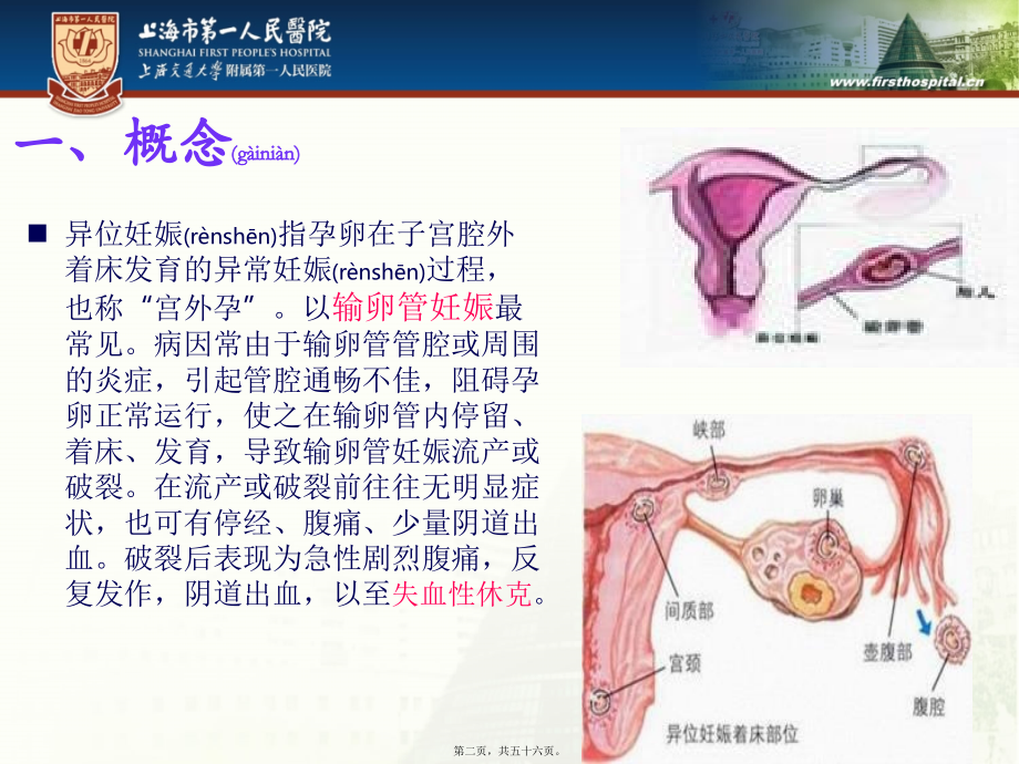 2022年医学专题—异位妊娠腹腔大出血的抢救配合.ppt_第2页