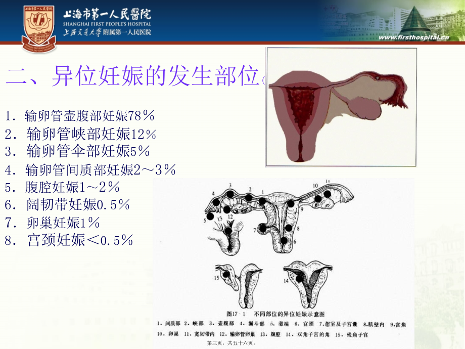 2022年医学专题—异位妊娠腹腔大出血的抢救配合.ppt_第3页