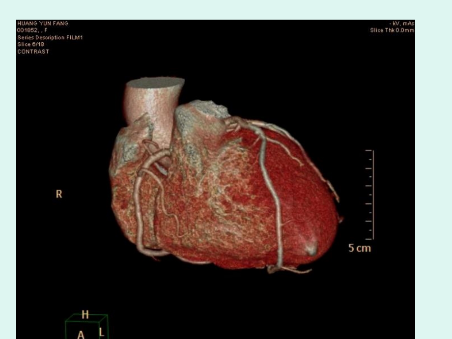 2022年医学专题—心脏冠状动脉CTA成像.ppt_第3页