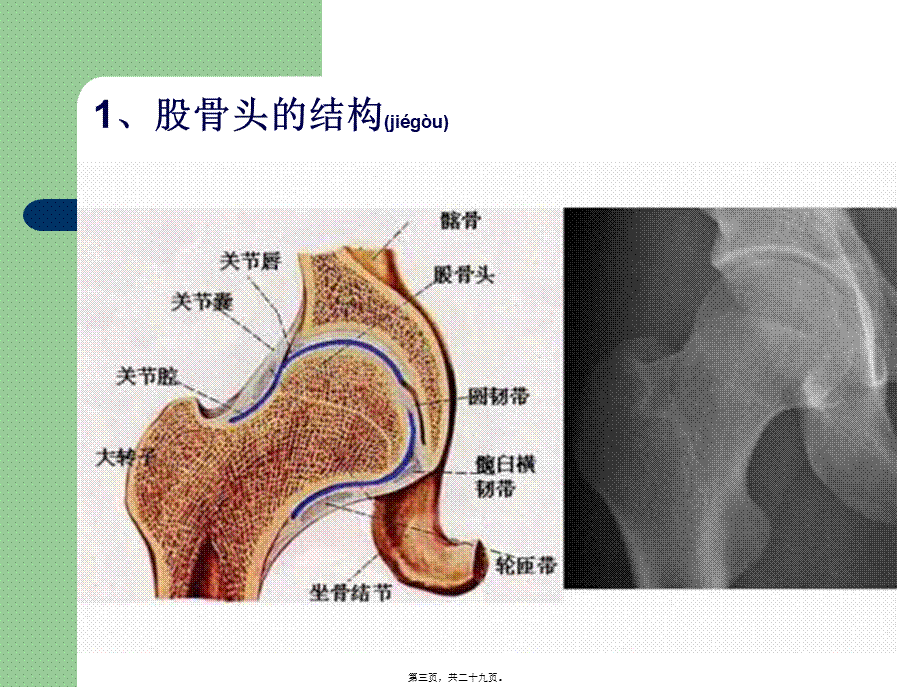 2022年医学专题—股骨头坏死(1)研究(1).ppt_第3页