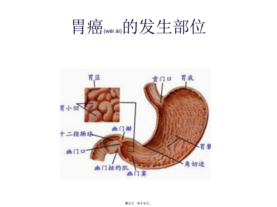 2022年医学专题—胃癌常见手术方式及术后并发症.ppt_第3页