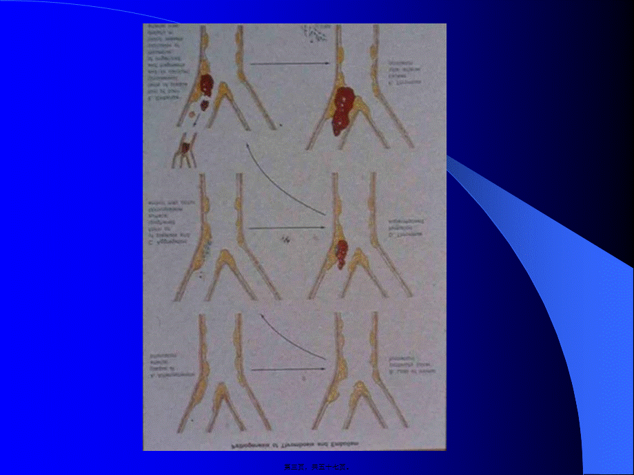2022年医学专题—周围动脉血栓与栓塞(1).ppt_第3页