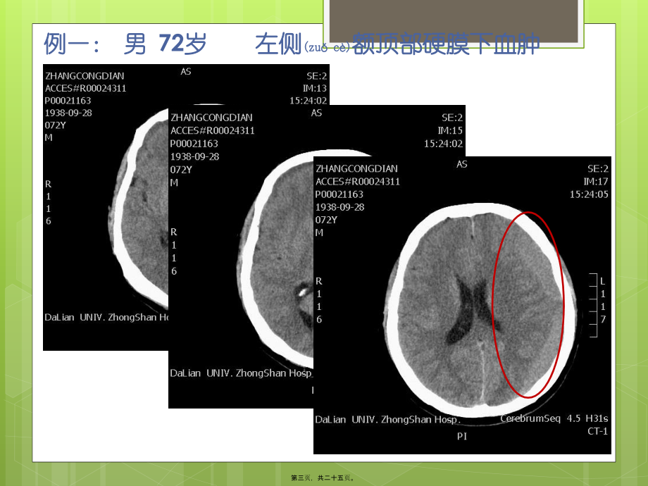 2022年医学专题—等密度硬膜下血肿的CT征象(1).pptx_第3页