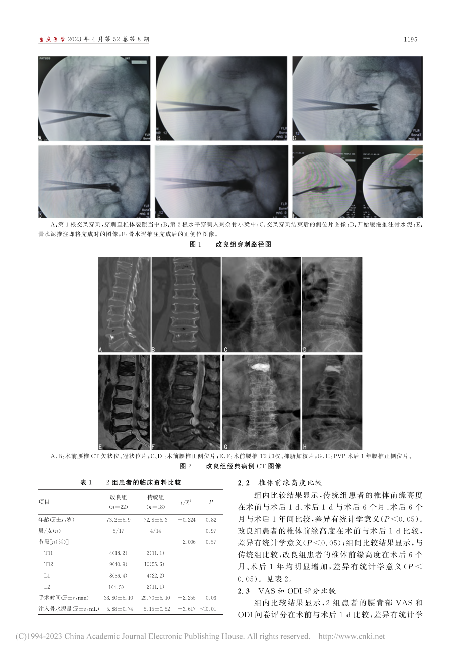 改良与传统穿刺经皮椎体成形...mmell病的临床疗效分析_皮昌军.pdf_第3页