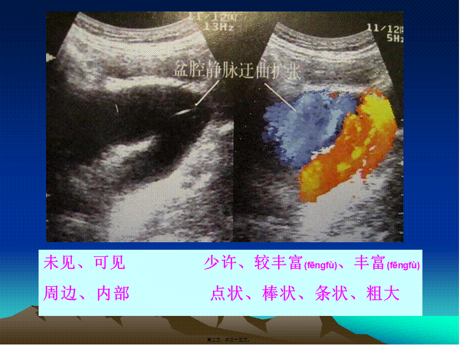 2022年医学专题—彩超在妇科方面的运用(1).ppt_第2页