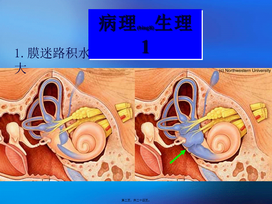 2022年医学专题—梅尼埃病七年制(1).ppt_第2页