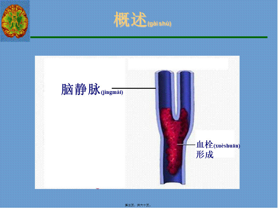 2022年医学专题—脑静脉系统血栓形成全面PPT概要(1).ppt_第3页