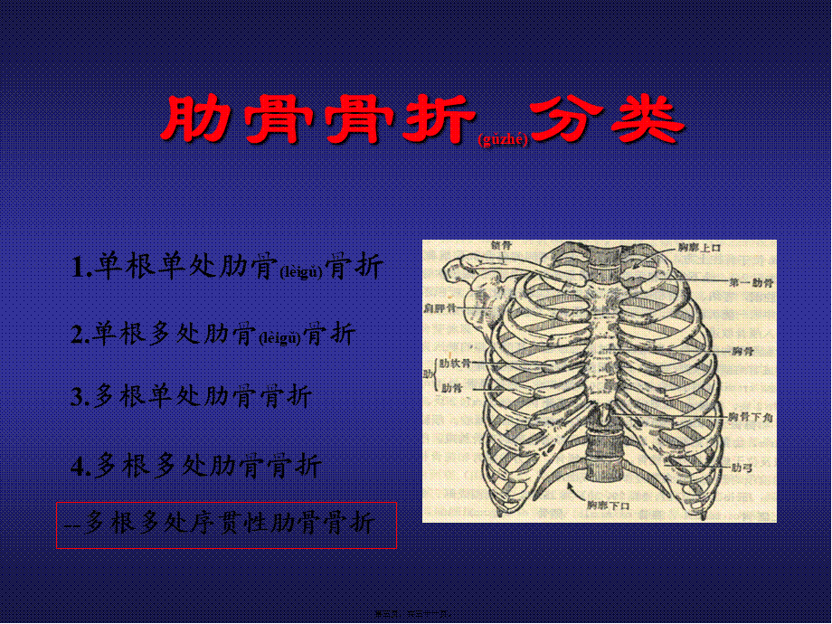 2022年医学专题—创伤性连枷胸合并ARDS(1).ppt_第3页