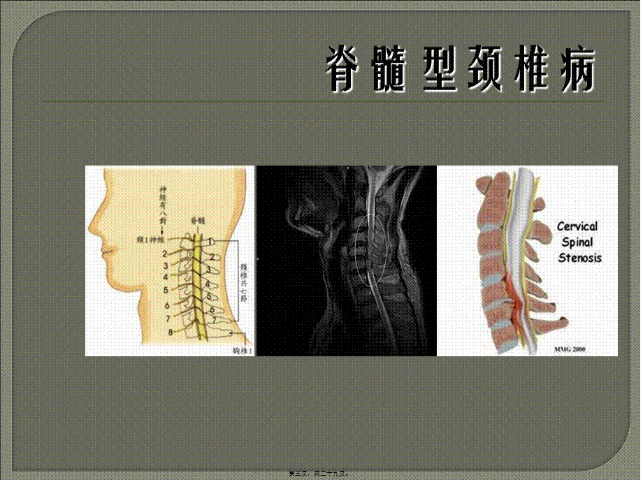 2022年医学专题—脊髓型颈椎病(1).ppt_第3页