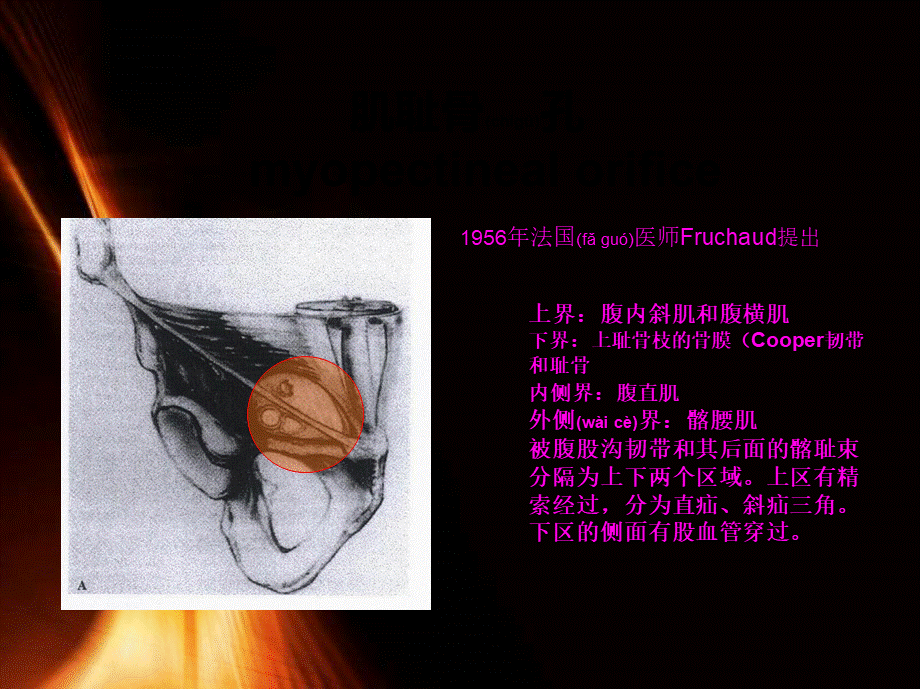 2022年医学专题—腹腔镜腹股沟疝(1).ppt_第2页