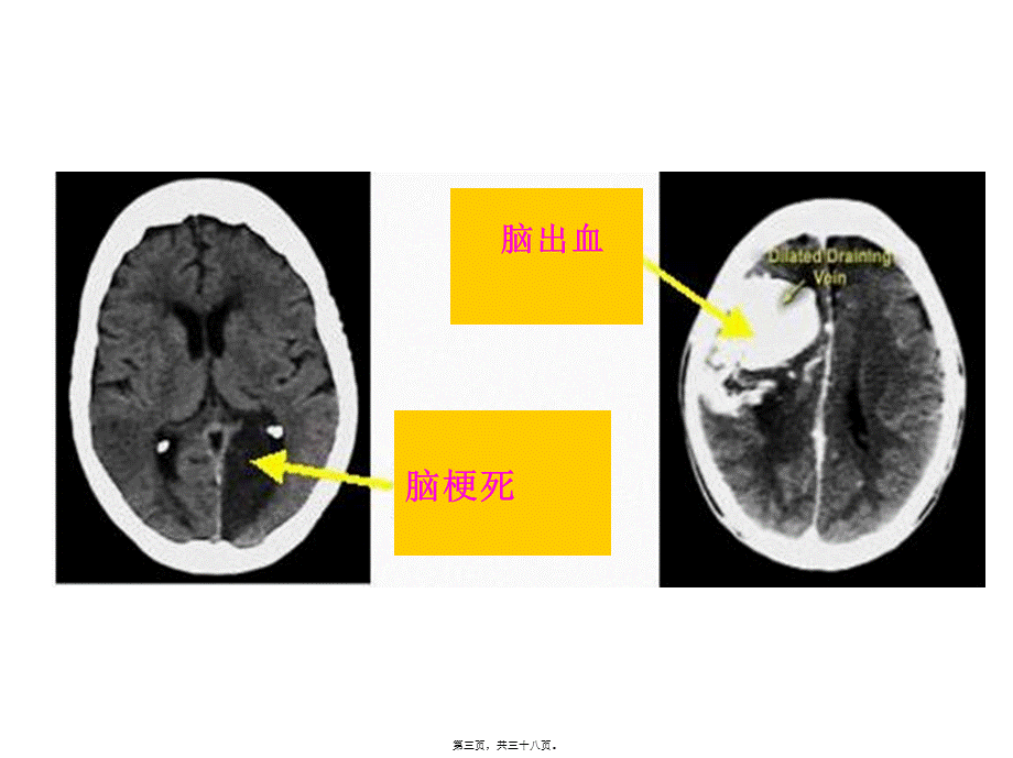 2022年医学专题—急性脑血管病(1).ppt_第3页