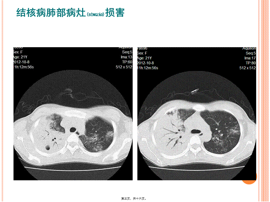 2022年医学专题—广州市学校结核病流行现况和防控工作规范1(1).pptx_第3页