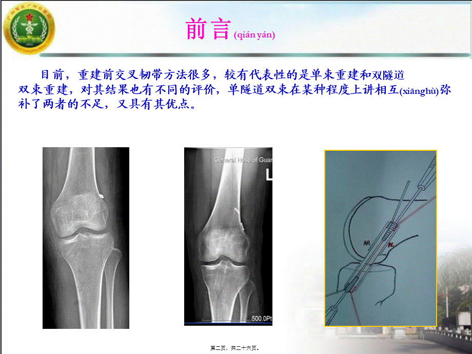 2022年医学专题—单隧道双束前交叉韧带重建的中期疗效观察(1).ppt_第2页