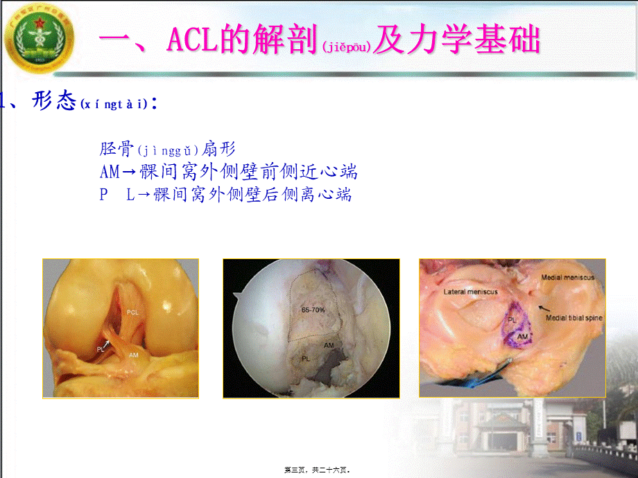 2022年医学专题—单隧道双束前交叉韧带重建的中期疗效观察(1).ppt_第3页