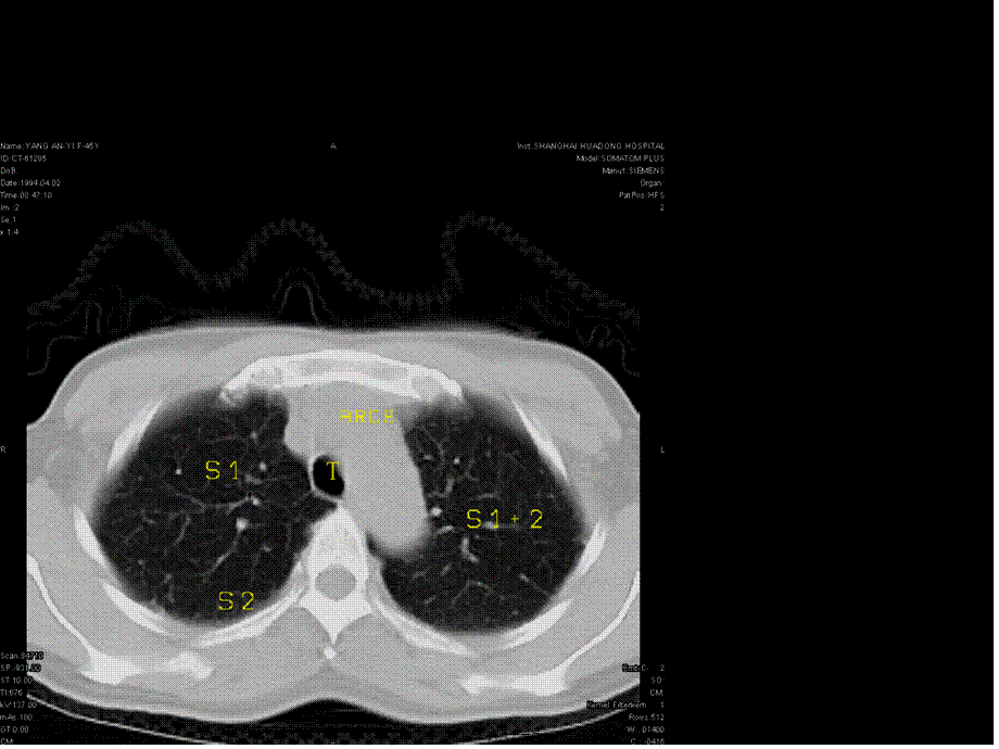 2022年医学专题—肺段ct(1).ppt_第2页