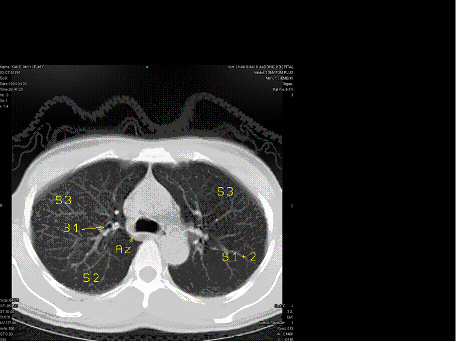 2022年医学专题—肺段ct(1).ppt_第3页