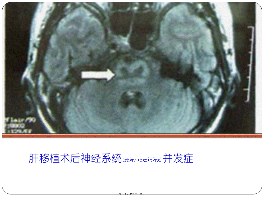 2022年医学专题—肝移植后神经系统并发症和术中脑功能(1).pptx_第3页