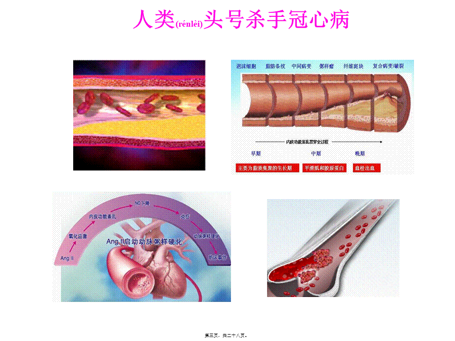 2022年医学专题—冠心病知识普及(1).ppt_第3页