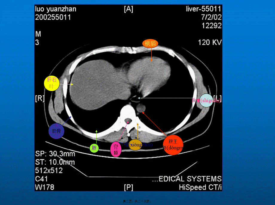 2022年医学专题—腹部CT各部位的简单记忆(1).ppt_第2页