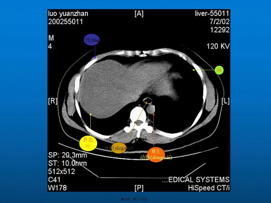 2022年医学专题—腹部CT各部位的简单记忆(1).ppt_第3页