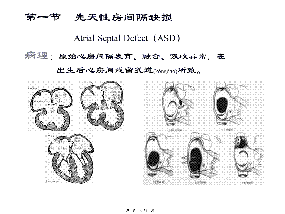 2022年医学专题—第十章-先天性心血管病(1).ppt_第3页